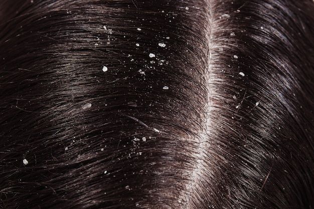 Gàu và ngứa da đầu gây khó chịu, mất tự tin